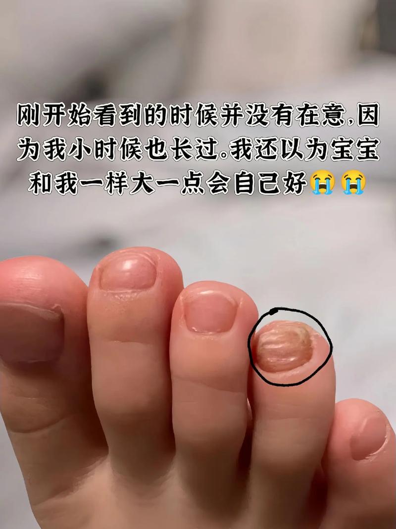 先心病新生儿指甲颜色异常意味着什么？是否与心脏病变程度相关？-第3张图片-郑州医学网