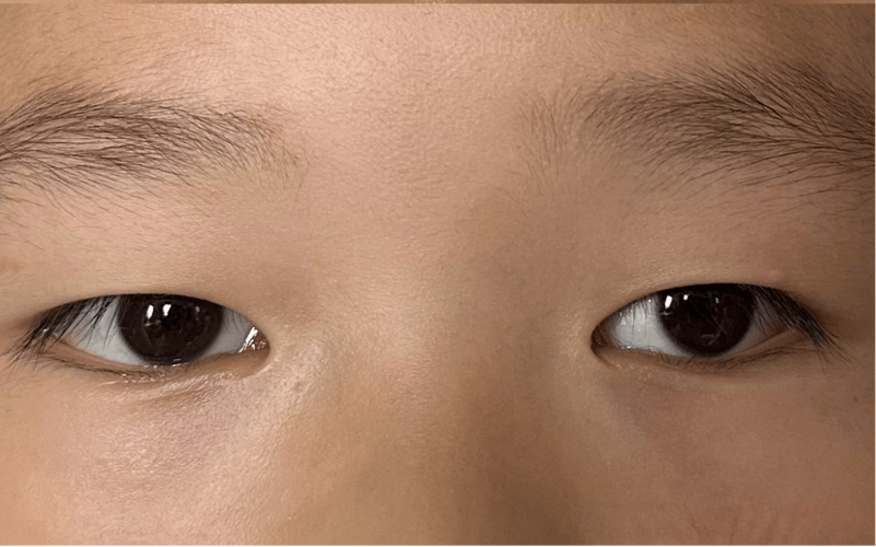 新生儿总是斜眼看东西是正常现象还是眼部发育异常？-第2张图片-郑州医学网