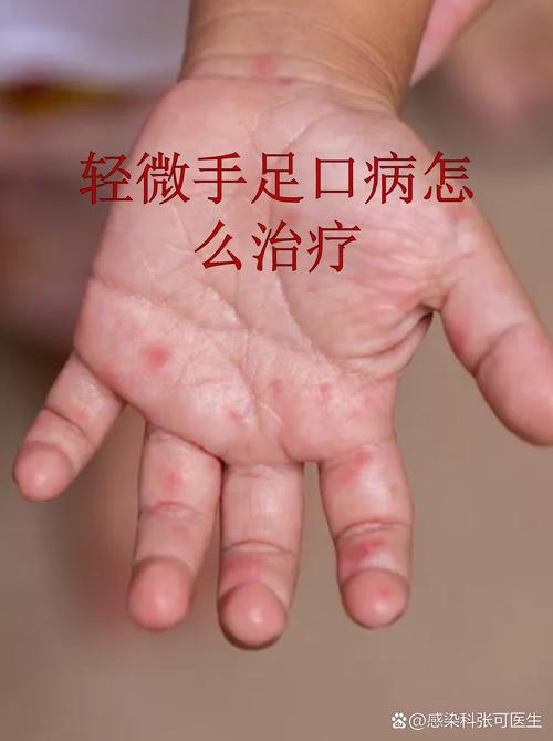 儿童手足口病怎么治疗？有哪些科学有效的护理方法和用药建议？-第1张图片-郑州医学网