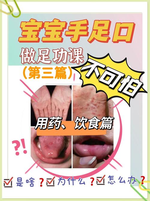 儿童手足口病怎么治疗？有哪些科学有效的护理方法和用药建议？-第3张图片-郑州医学网