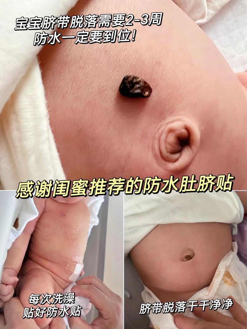 新生儿肚脐迟迟不脱落,是正常现象还是需要警惕的健康问题?-第3张图片-郑州医学网 新生儿肚脐迟迟不脱落,是正常现象还是需要警惕的健康问题?-第3张图片-郑州医学网