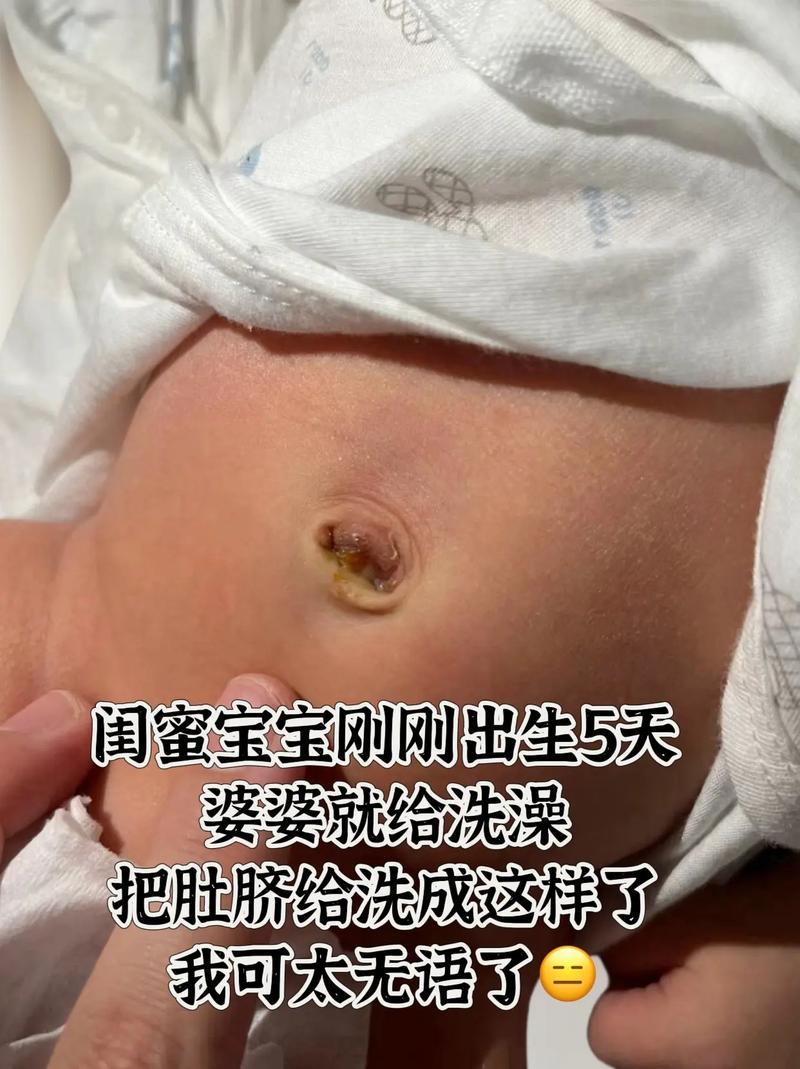 新生儿肚脐迟迟不脱落，是正常现象还是需要警惕的健康问题？-第2张图片-郑州医学网