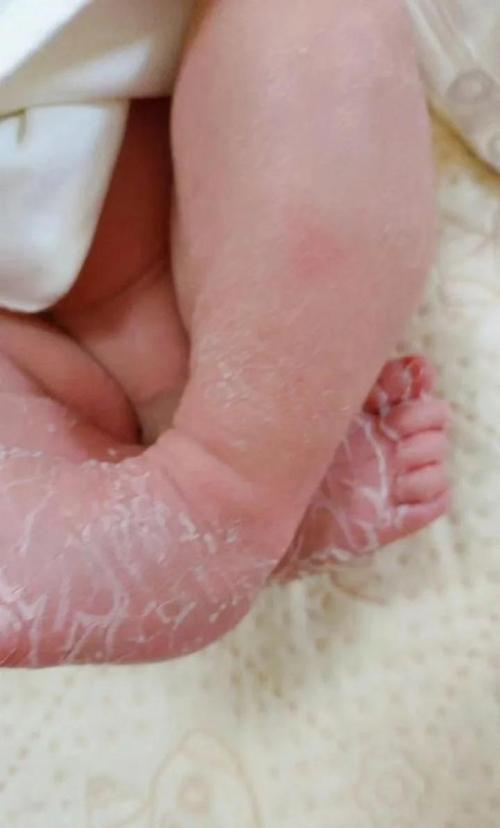 新生儿大腿根部蜕皮正常吗?需要特殊护理还是就医?-第1张图片-郑州医学网 新生儿大腿根部蜕皮正常吗?需要特殊护理还是就医?-第1张图片-郑州医学网