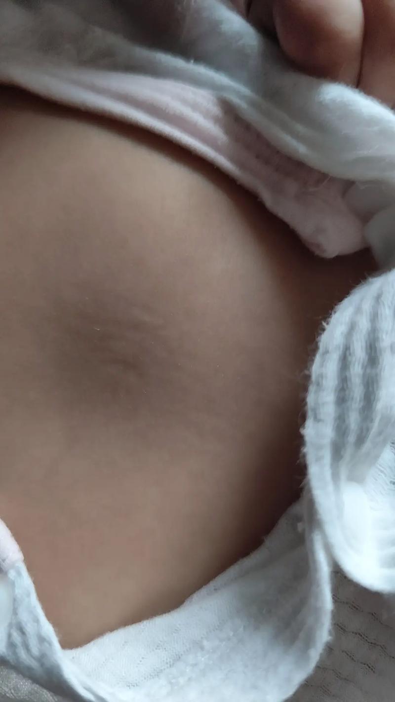 新生儿大腿根部蜕皮正常吗？需要特殊护理还是就医？-第3张图片-郑州医学网