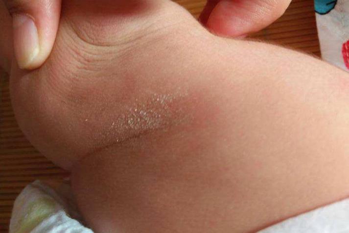 新生儿大腿根部蜕皮正常吗？需要特殊护理还是就医？-第2张图片-郑州医学网