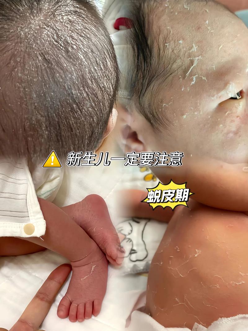 新生儿褶皱处破皮发白-第1张图片-郑州医学网 新生儿褶皱处破皮发白-第1张图片-郑州医学网
