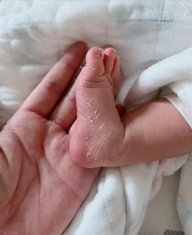 新生儿褶皱处破皮发白-第3张图片-郑州医学网 新生儿褶皱处破皮发白-第3张图片-郑州医学网