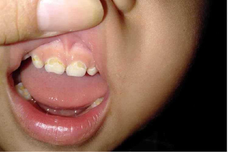 新生儿牙齿上的黄黄东西是正常现象还是需要处理的牙菌斑？-第3张图片-郑州医学网