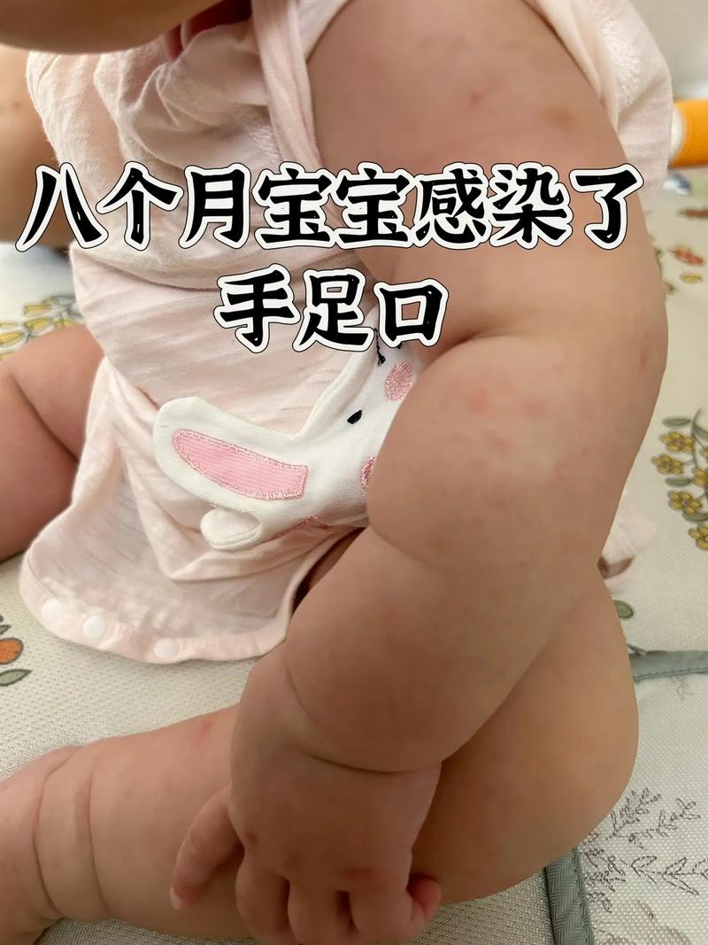 新手爸妈如何准确判断新生儿手足口病？这些关键症状别忽略！-第2张图片-郑州医学网