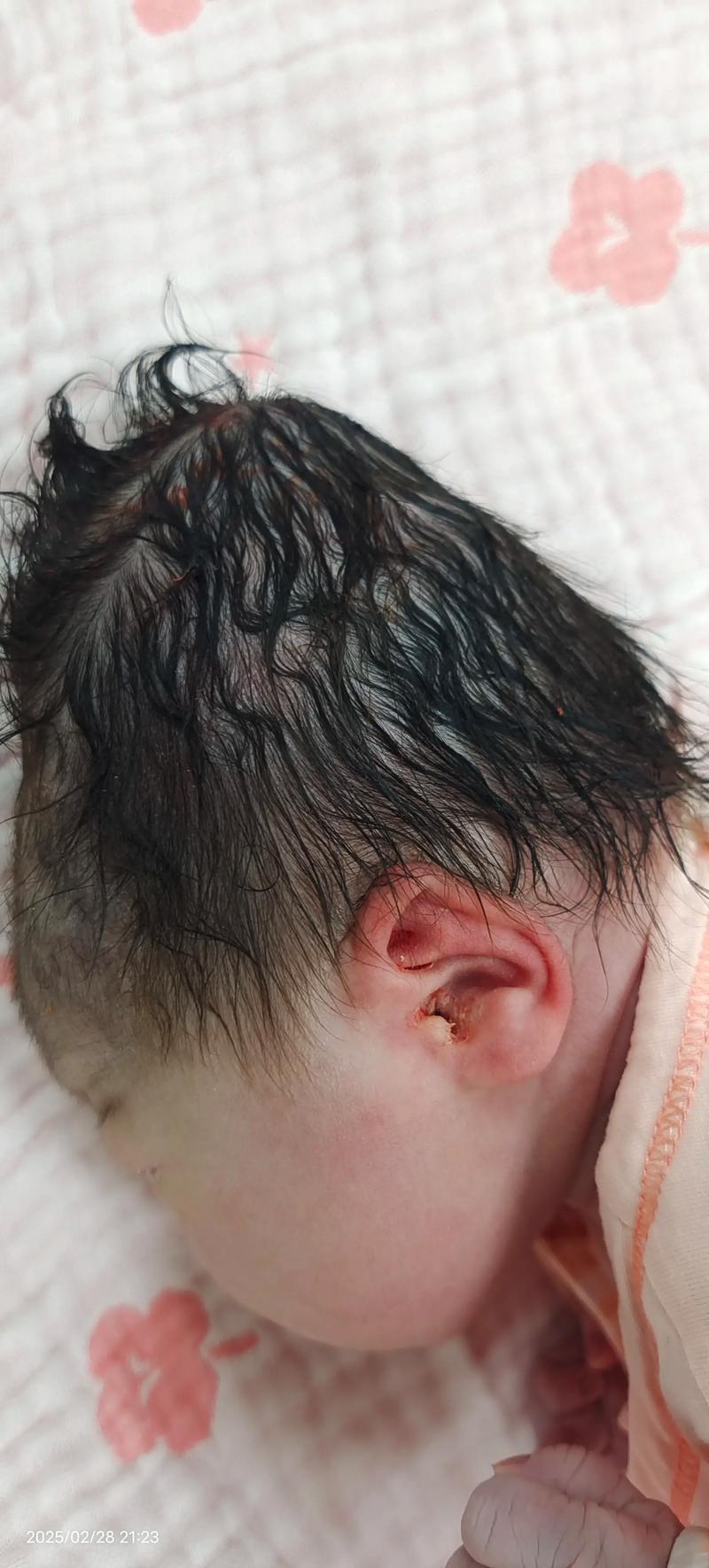 新生儿头颅血肿到底能不能热敷？这样做会不会加重风险？-第2张图片-郑州医学网