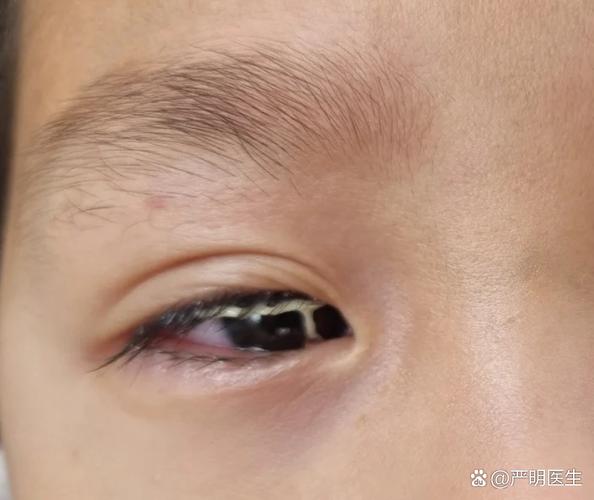 新生儿眼睛有白色眼屎是正常现象还是感染信号？需如何处理？-第2张图片-郑州医学网