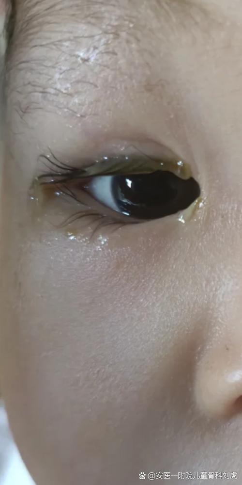 新生儿眼睛有白色眼屎是正常现象还是感染信号？需如何处理？-第1张图片-郑州医学网