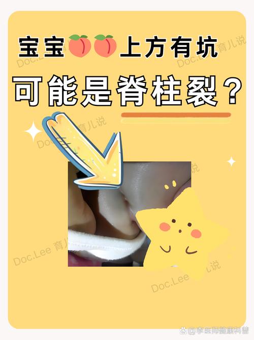 儿童脊柱裂的症状图片具体有哪些表现?如何通过图片识别早期症状?-第1张图片-郑州医学网 儿童脊柱裂的症状图片具体有哪些表现?如何通过图片识别早期症状?-第1张图片-郑州医学网