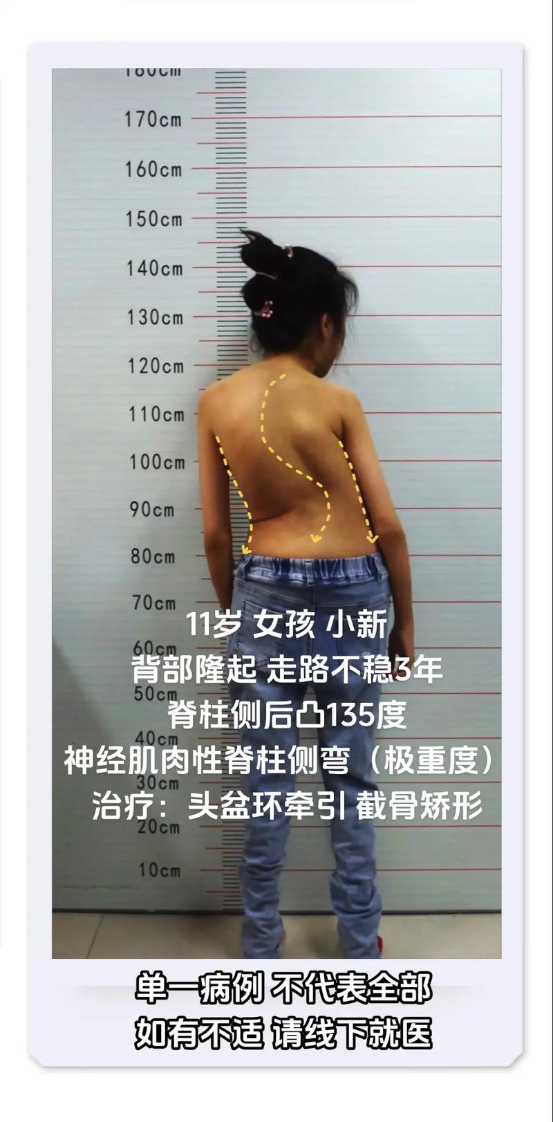 儿童脊柱裂的症状图片具体有哪些表现?如何通过图片识别早期症状?-第3张图片-郑州医学网 儿童脊柱裂的症状图片具体有哪些表现?如何通过图片识别早期症状?-第3张图片-郑州医学网