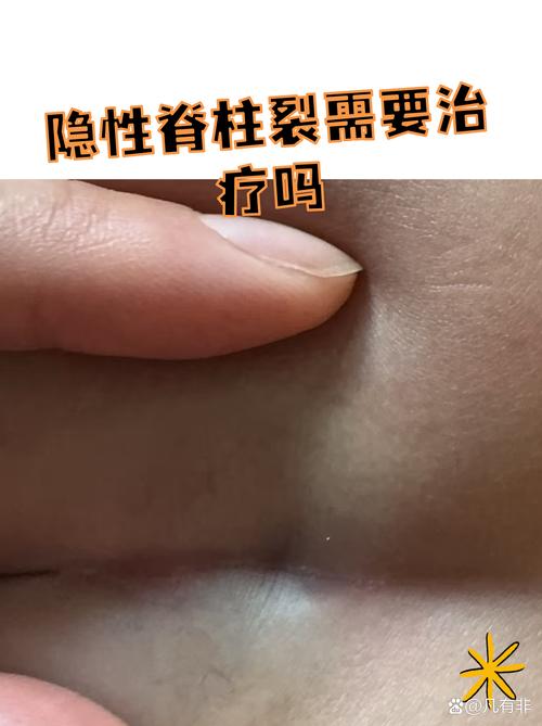 儿童脊柱裂的症状图片具体有哪些表现?如何通过图片识别早期症状?-第2张图片-郑州医学网 儿童脊柱裂的症状图片具体有哪些表现?如何通过图片识别早期症状?-第2张图片-郑州医学网